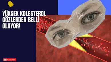 Yüksek Kolesterol Gözlerden Belli Oluyor!