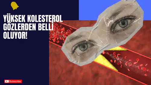 Yüksek Kolesterol Gözlerden Belli Oluyor!